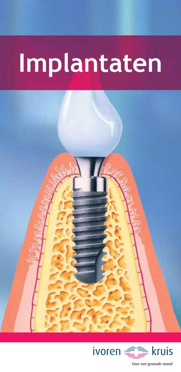 folder-implantaten